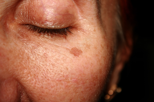 Dark spots on face