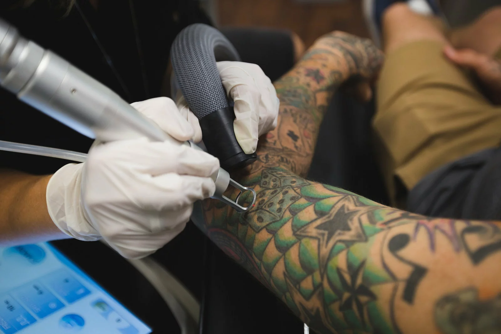 Détatouage au laser